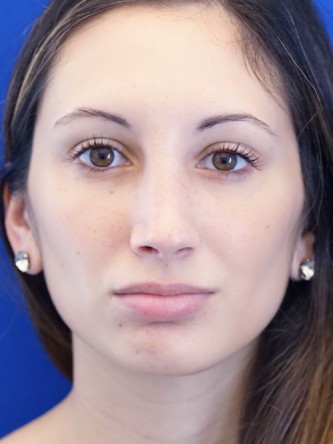 Nasal Profile Aesthetics — After