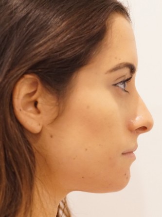 Restylane Silk to Volumize Lower Lip* — Before