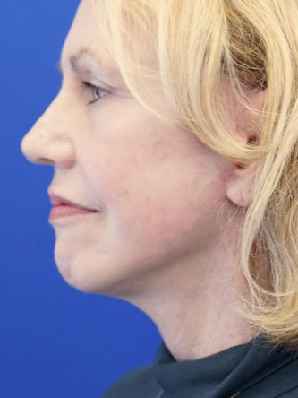Deep Plane Lift and Superficial Laser — After