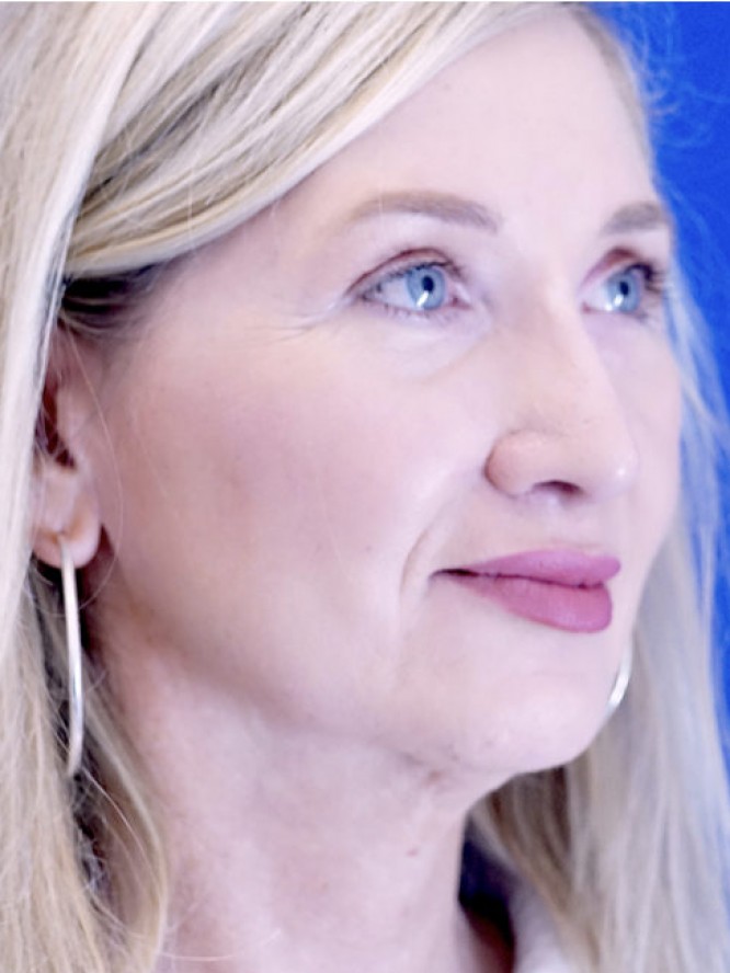 Thick Skin Droopy Nose — After