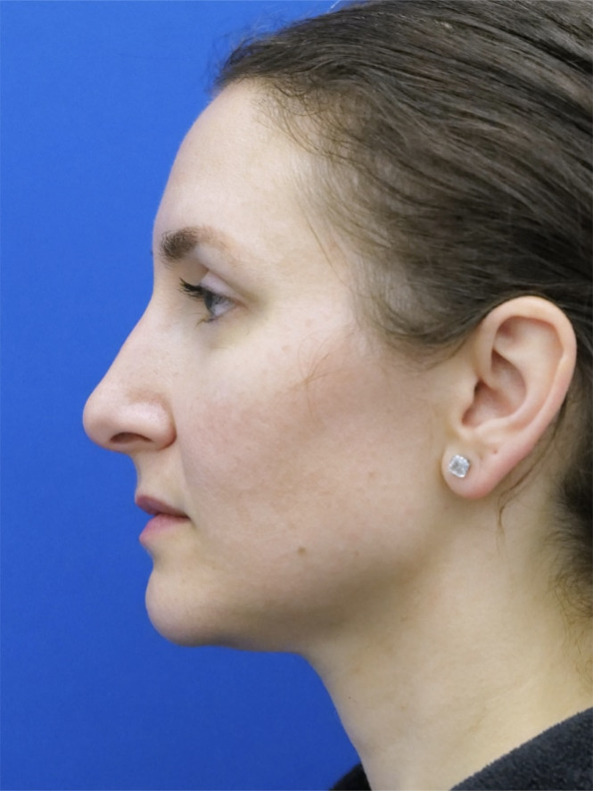 Tip Projection — Before