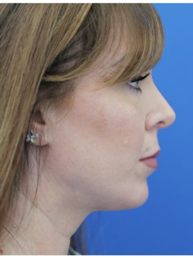 Dorsal Preservation and Refinement — After