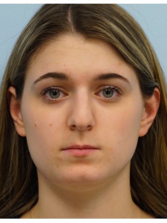 Droopy Tip Endonasal Rhinoplasty* — Before