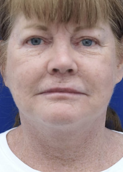 Surgical Neck Lift — After