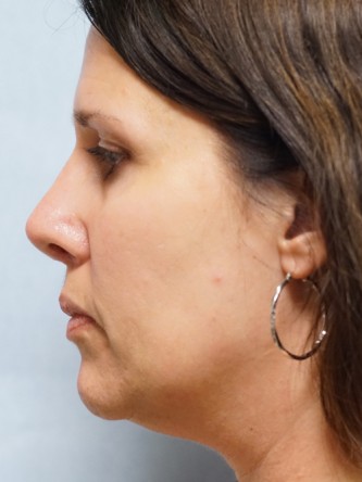 Tip Asymmetry and Hanging Columella* — After