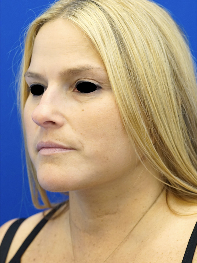 Deep Plane Lower Facelift and Platysmaplasty — After