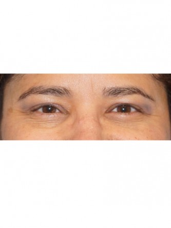 Right Ptosis Repair* — After