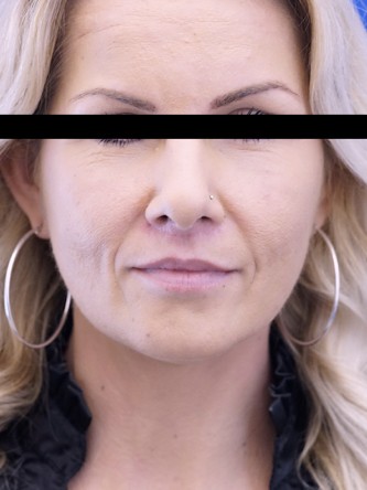 Upper Lip Shortening — After