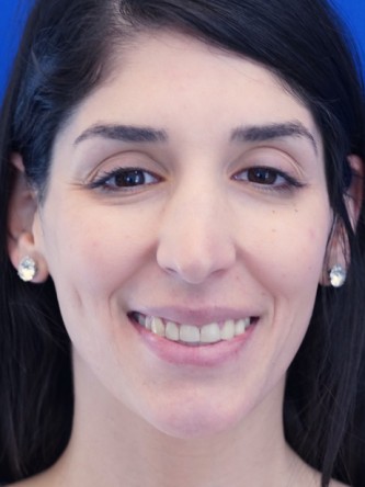Nasal Bridge Bump* — Before