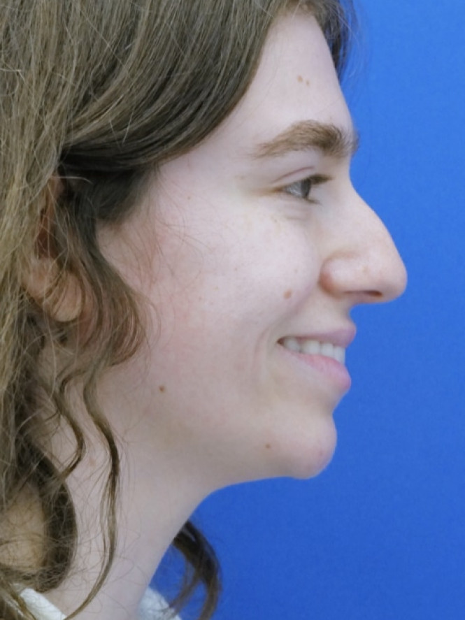 Preservation Rhinoplasty1 — Before