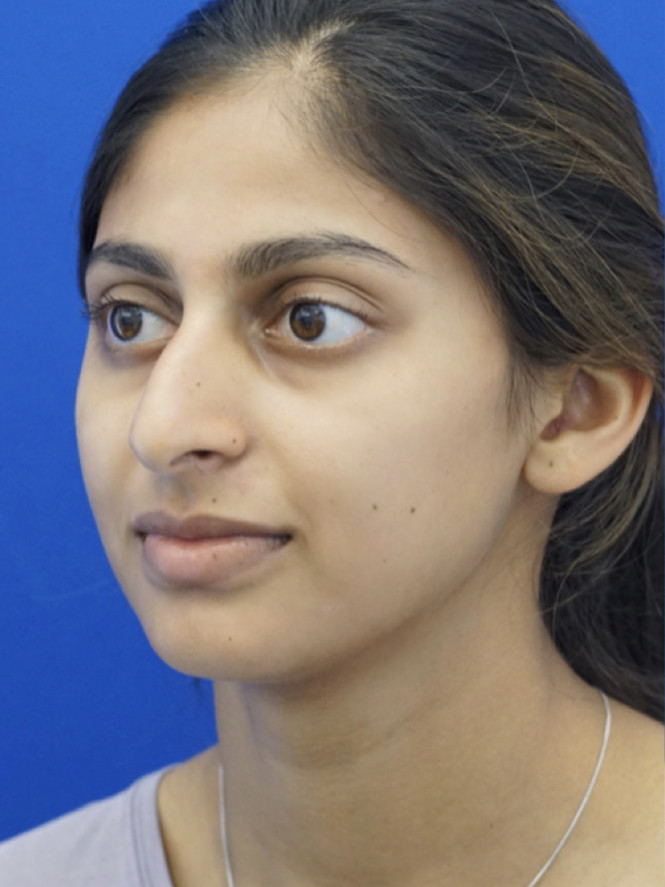Natural Result — Before