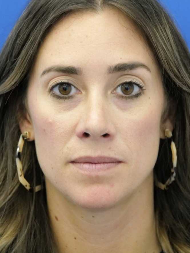 Preservation Rhinoplasty — After
