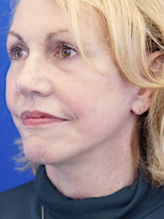 Deep Plane Lift and Superficial Laser — After
