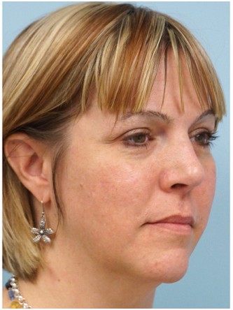Cheek Augmentation using Voluma* — Before