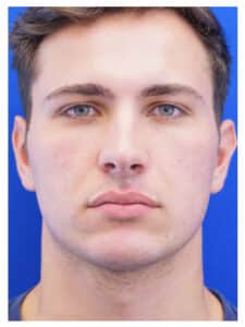 Procedure information from Mao Facial Plastic Surgery