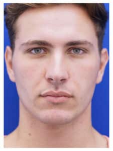 Procedure information from Mao Facial Plastic Surgery