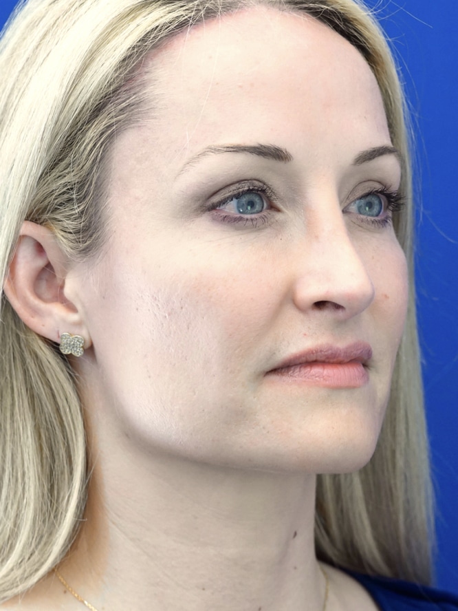 Procedure information from Mao Facial Plastic Surgery