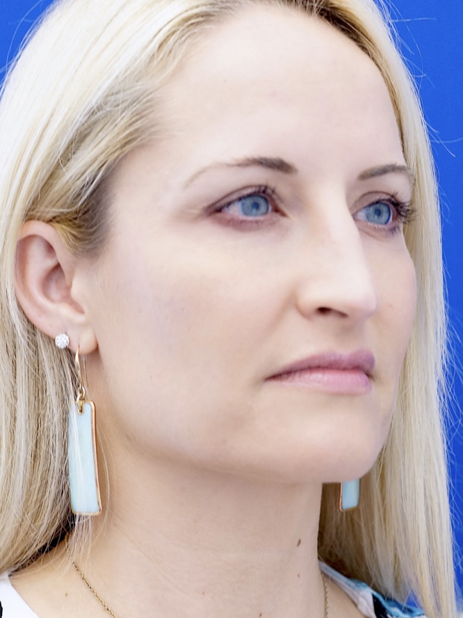 Procedure information from Mao Facial Plastic Surgery